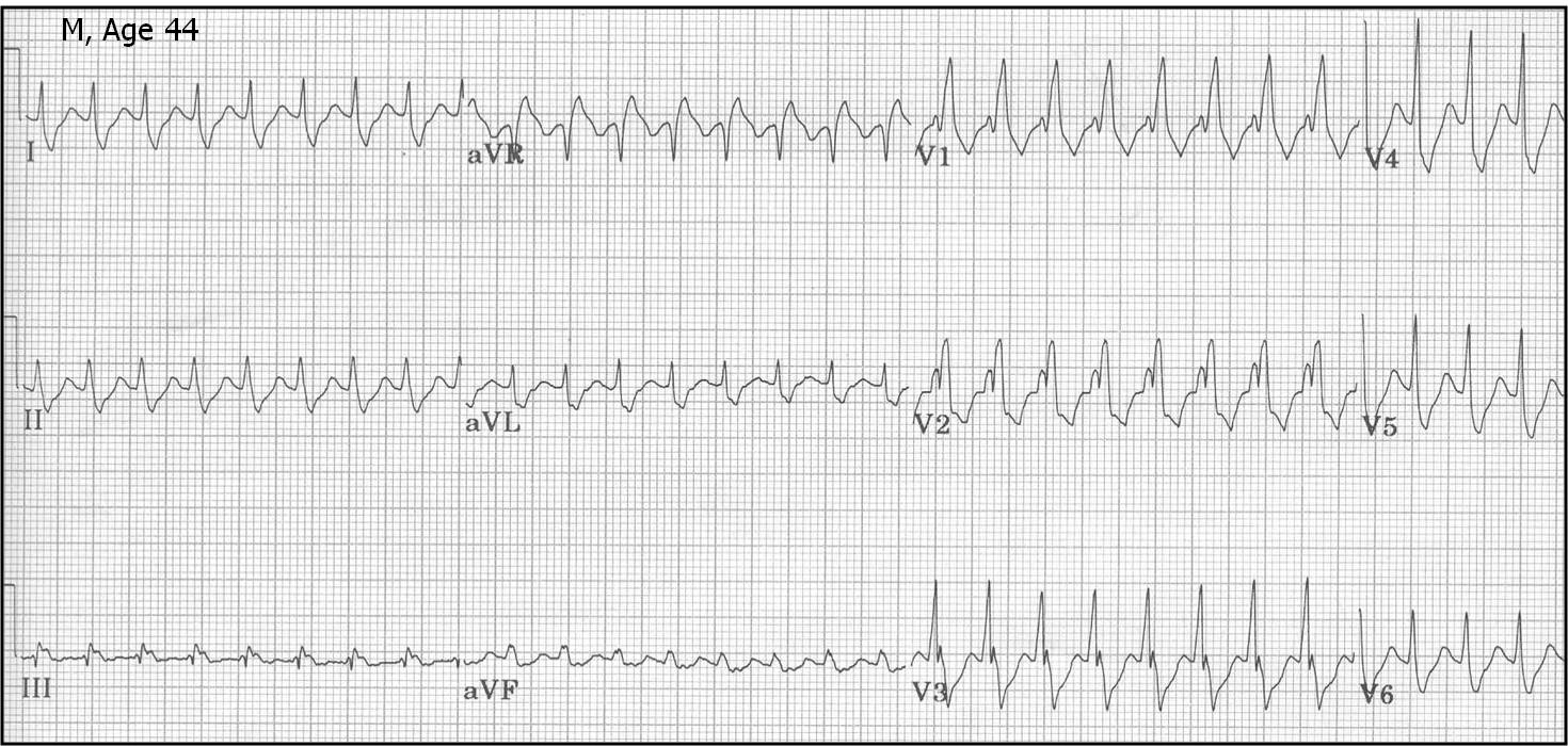 ЭКГ наджелудочковой тахикардии